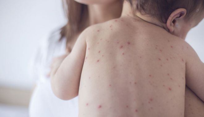 Copil mort de rujeolă, frații săi - în spital. Niciunul nu e vaccinat - istock85432299medium-1525346048.jpg