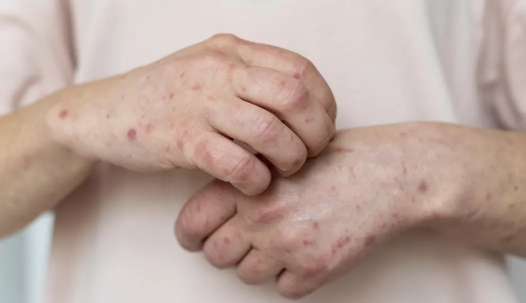 Un nou caz de lepră a fost confirmat în România, la sora primei paciente - lepra-1765544183.webp