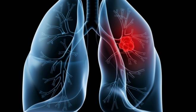S-a descoperit alimentul ce ucide 85% din celulele cancerului pulmonar - lungcancer83729700-1439019966.jpg