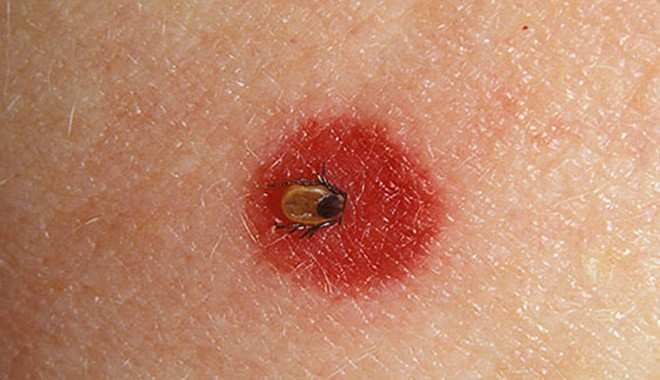 Ce semnal de alarmă trag pacienții cu boala Lyme - lyme-1368152556.jpg