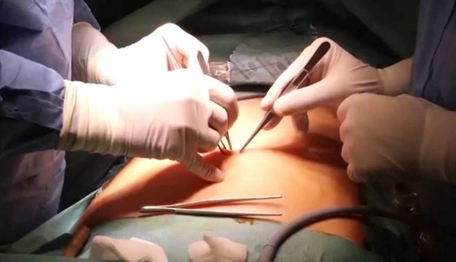 Operaţie inedită a medicilor de la un spital judeţean de urgenţă. Este incredibil ce au extras din stomacul unui pacient!