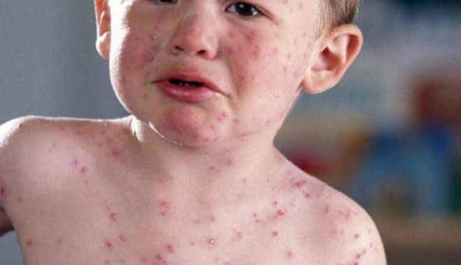 EPIDEMIE DE RUJEOLĂ / Vești bune pentru părinți, de la ministrul Sănătății - measlesrubella-1493731837.jpg