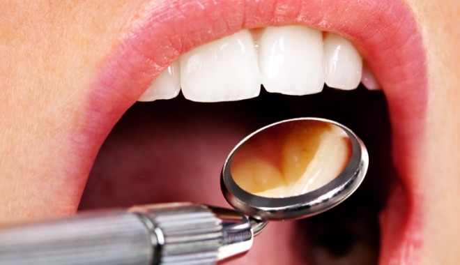 Probleme cu gingiile și la tinerețe? - medicproblemegingii-1398448868.jpg