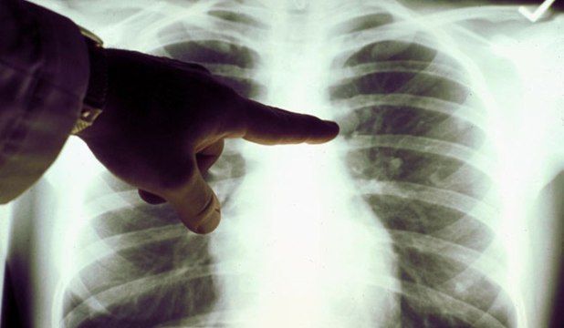 Investigații gratuite pentru depistarea cancerului pulmonar - medstarcancerpulmonar22ianuarie-1421941957.jpg