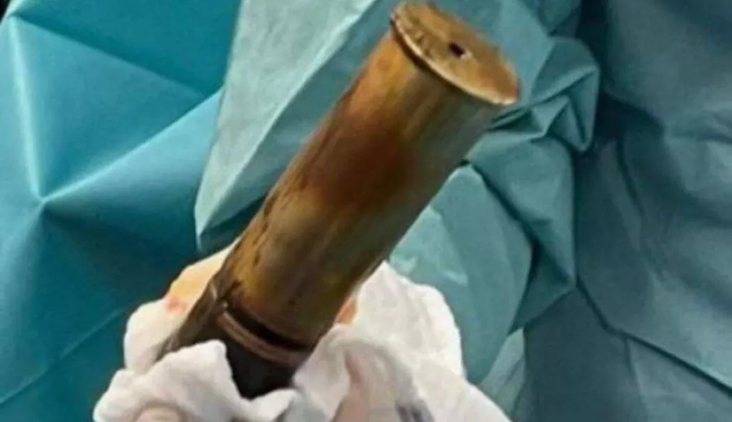 Un bărbat cu un obuz înfipt în rect a evacuat un spital întreg - obuz-1770111339.webp