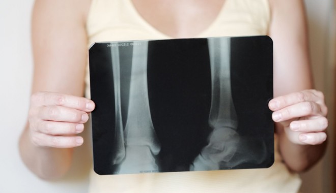 Osteoporoza, o boală răspândită  care trebuie să vă trimită la consultație - osteoporoza-1407860657.jpg