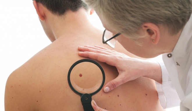 Cancerul de piele face ravagii - piele-1493042617.jpg