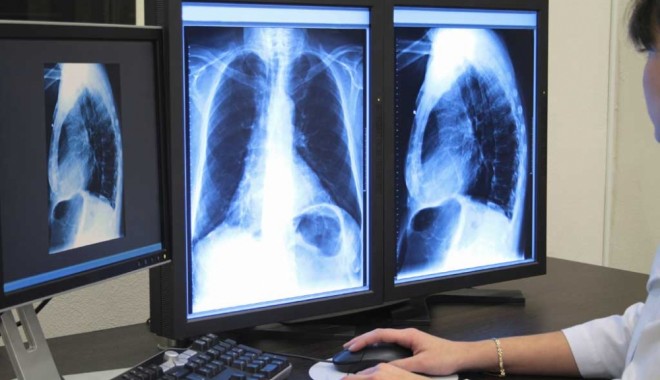 Bolnavii de cancer pulmonar au la dispoziție un ghid special - plamani1352846980-1385556184.jpg