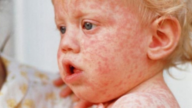 Un nou deces cauzat de rujeolă: Copilul nu era vaccinat! - pojar17587500-1510928686.jpg