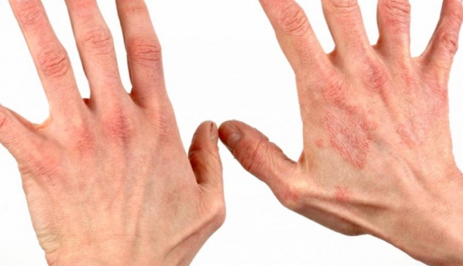 Agenția Europeană pentru Medicamente recomandă aprobarea unui nou medicament pentru tratarea psoriazisului - ps-1505570427.jpg