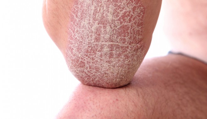 Psoriazisul - boala de care nu scapi niciodată - psoriazis-1319995334.jpg