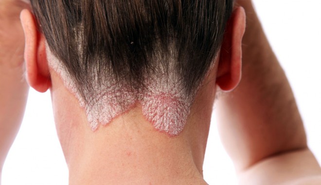Psoriazisul, boala declanșată de stres - psoriazis-1364490614.jpg
