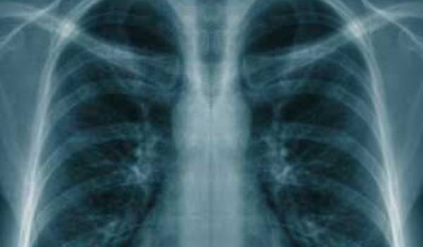 Peste jumătate din populație prezintă risc de boli pulmonare - radio-1368448764.jpg