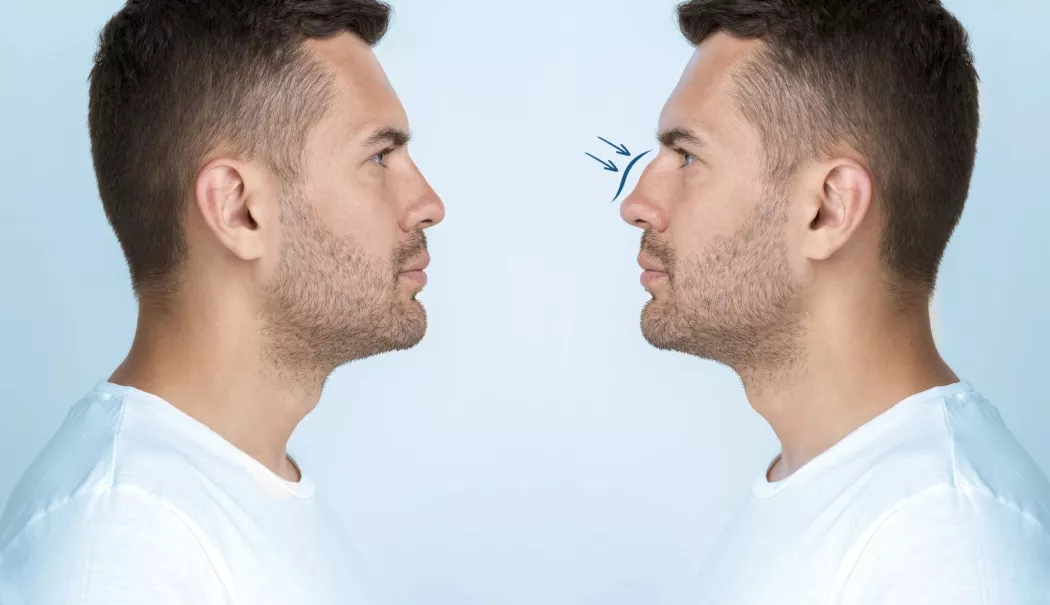 Vă gândiți la o rinoplastie? Ce ar trebui să știți înainte de operație