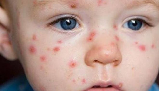 Epidemia uitată a României revine în forță - rujeol-1595230202.jpg
