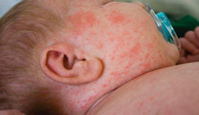 Statistică groaznică a epidemiei de rujeolă: 2.015 cazuri și 11 decese - rujeola-1483705409.jpg