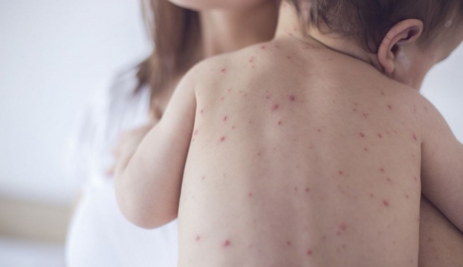 Bilanțul epidemiei de rujeolă: 4.881 de cazuri și 22 de decese - rujeola-1492790371.jpg