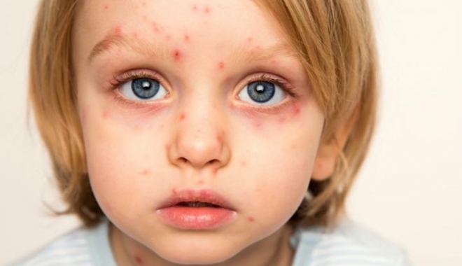 Epidemia de rujeolă este de neoprit. 24 de cazuri noi numai în ultima săptămână - rujeola-1509784780.jpg