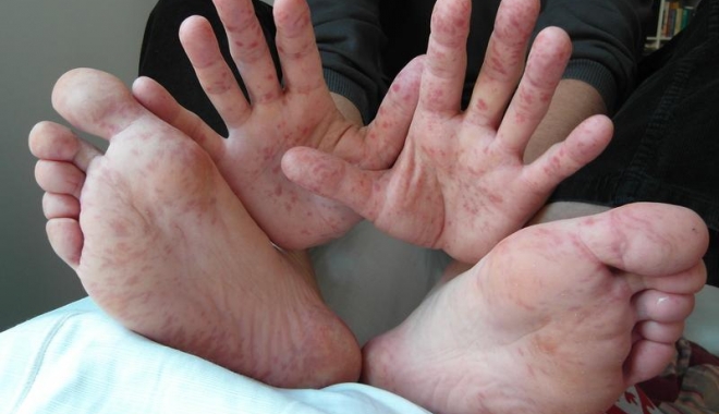 Un alt copil nevaccinat A MURIT ASTĂZI DE RUJEOLĂ - rujeola-1515160321.jpg