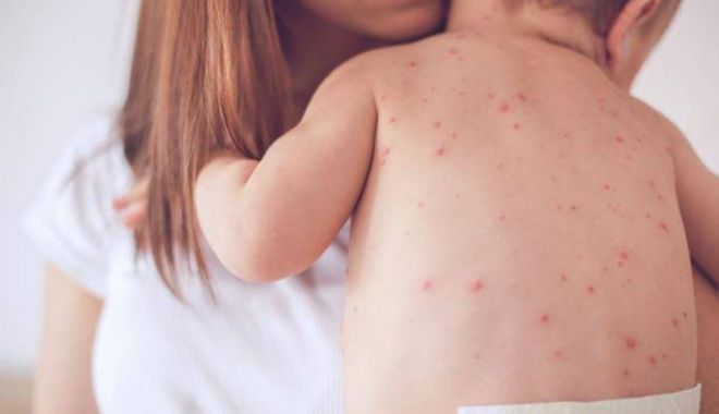 Epidemie de rujeolă la Constanța - rujeola-1528800993.jpg