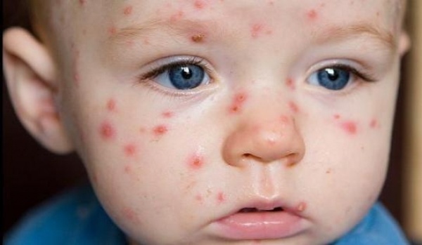 UNICEF a lansat un semnal de alarmă! Boala asta face ravagii la nivel mondial! - rujeola-1551463936.jpg