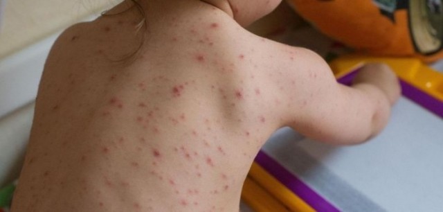 România sub amenințarea unei noi epidemii! Boala care face deja revagii
