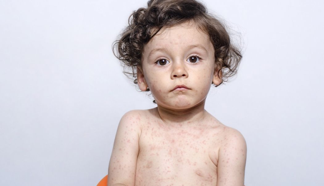 Rujeola poate provoca infecții ale urechii şi chiar convulsii - rujeola-1734352116.jpg