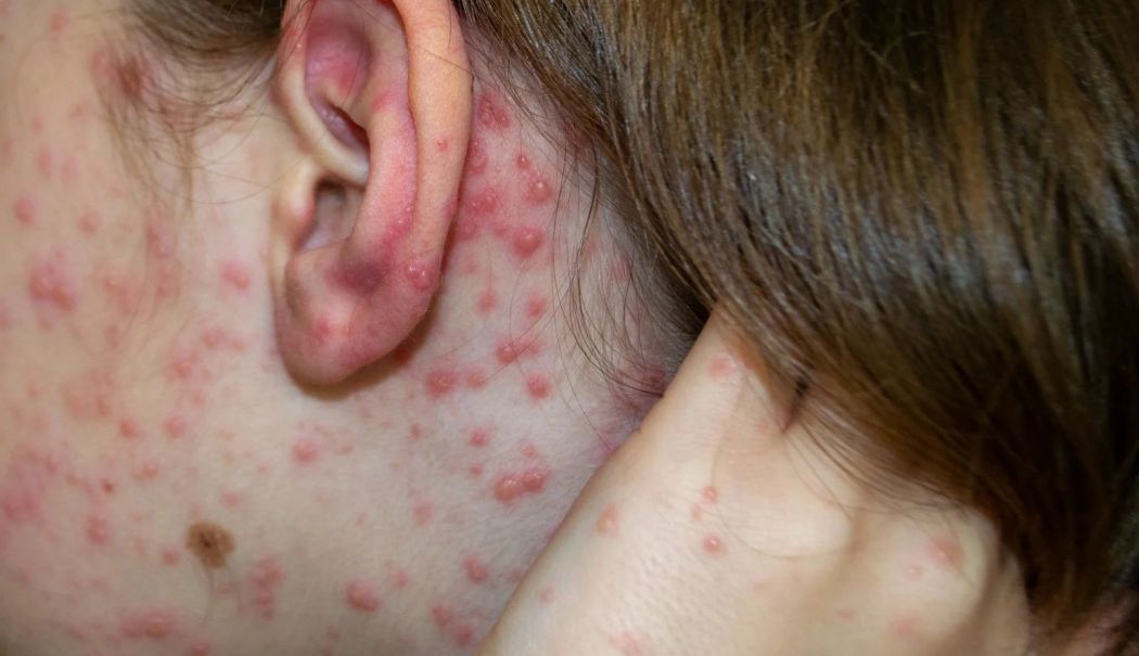 O boală foarte contagioasă afectează Europa. România se confruntă cu cea mai mare epidemie