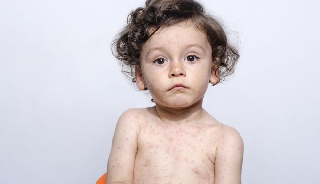 Rujeola poate provoca infecții ale urechii şi chiar convulsii - rujeola-2-1702557177.jpg