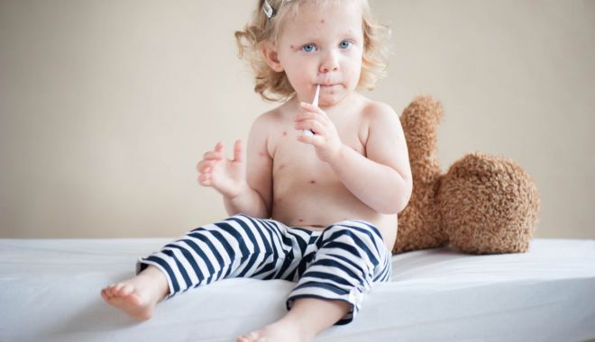 Părinți, feriți-vă copiii de rujeolă! Vaccinați-i! - rujeola1-1523781462.jpg