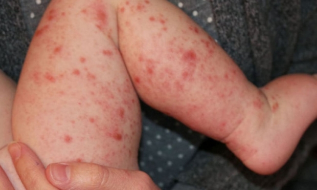 Rujeola face ravagii: sunt încă 34 de cazuri în numai o săptămână - rujeoladinnou24921700-1564818635.jpg