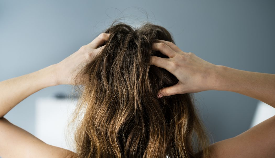 Metode simple și rapide care vă scapă de scalpul uscat - scalp-1712752470.jpg
