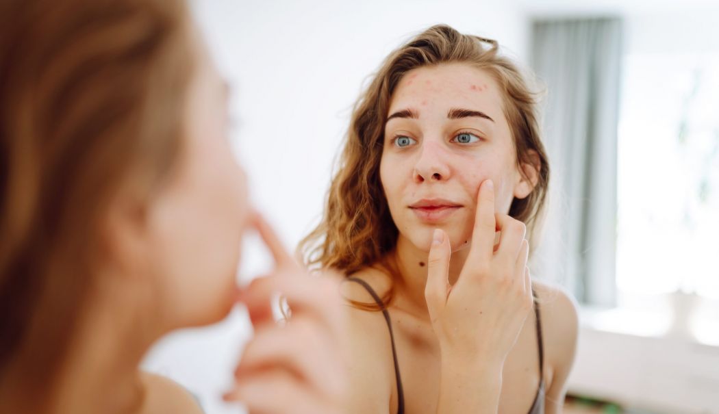 Cum faceţi diferența între dermatită seboreică și psoriazis - scalp-1759069448.jpg