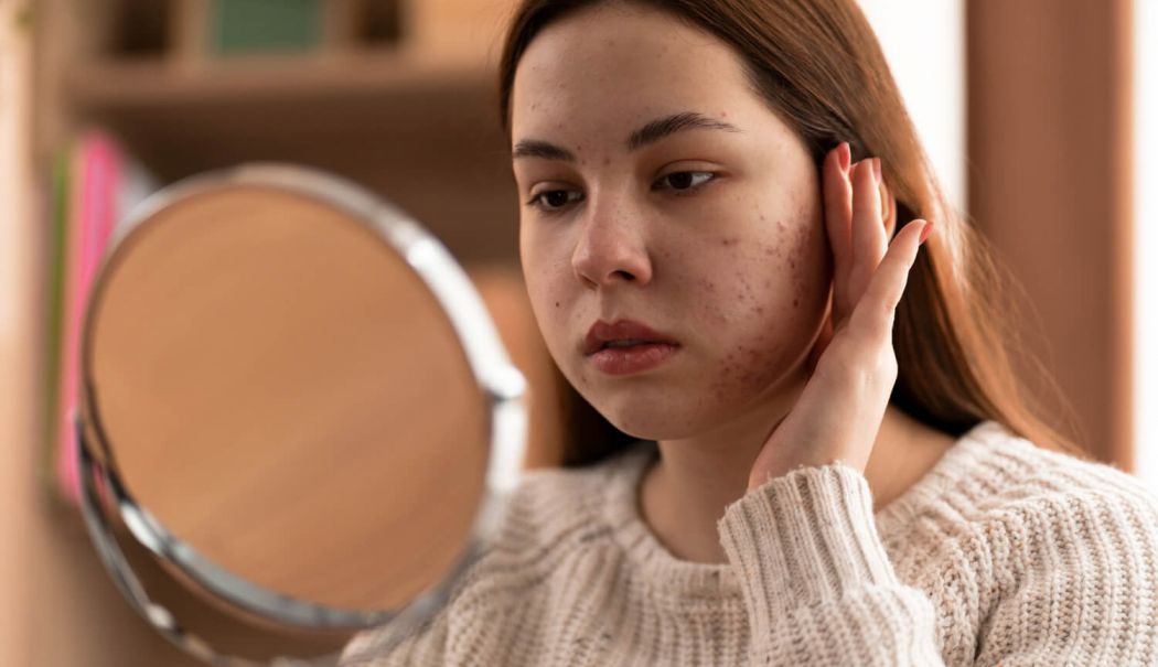 Excesul de sebum duce la probleme cu pielea, acnee și pori blocați - sebum-1740752457.jpg