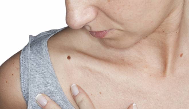 Care este principala cauză pentru cancerul de piele - skincancershoulder1-1429784442.jpg