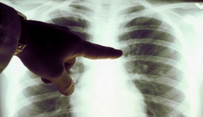 Profesoară diagnosticată cu TBC. Peste 150 de elevi, testați medical pentru tuberculoză - tbc88822500-1548061262.jpg