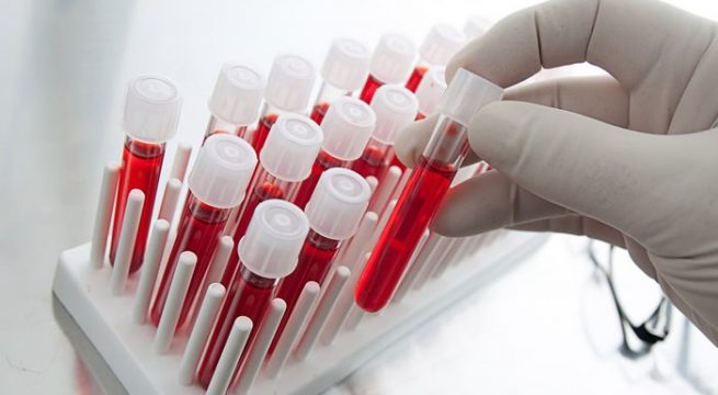 Un test special poate diagnostica, rapid, tuberculoza - test-1490790851.jpg