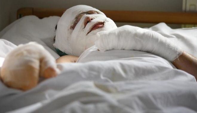Pacienții cu arsuri grave vor putea fi tratați în Belgia