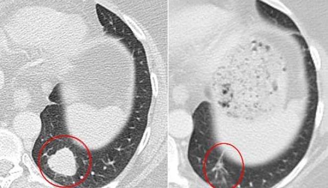 CEA MAI IMPORTANTĂ DESCOPERIRE DUPĂ CHIMIOTERAPIE! Imunoterapia a tratat cele mai agresive forme de cancer - tumora465x390-1433161416.jpg