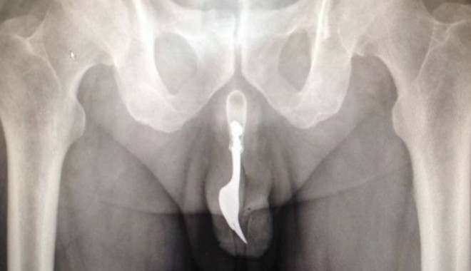 GEST ȘOCANT! Și-a înfipt în penis o furculiță lungă de 10 centimetri! A ajuns la URGENȚĂ - untitled-1377001711.jpg