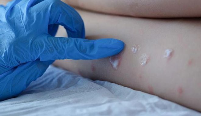 Răsturnare de situaţie în cazul bărbatului diagnosticat recent cu VARIOLA MAIMUŢEI!