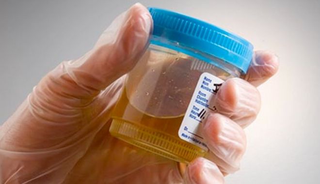 Culoarea urinei este influențată de unele alimente sau medicamente - urina-1687524166.jpg