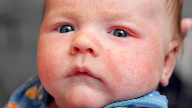 Urticaria spontana cronică, impact major asupra vieții pacientului - urticaria-1480007257.jpg