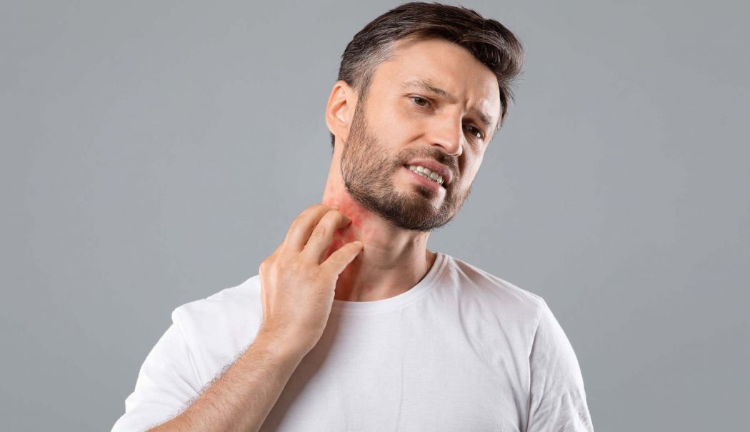 Atunci când este frig, urticaria poate determina scăderea tensiunii arteriale - urticarie-1736430282.jpg