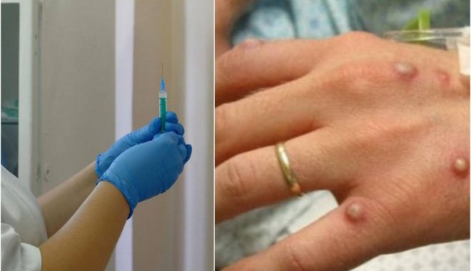 Variola maimuței a ajuns în România. Virusul, depistat la un bărbat din București