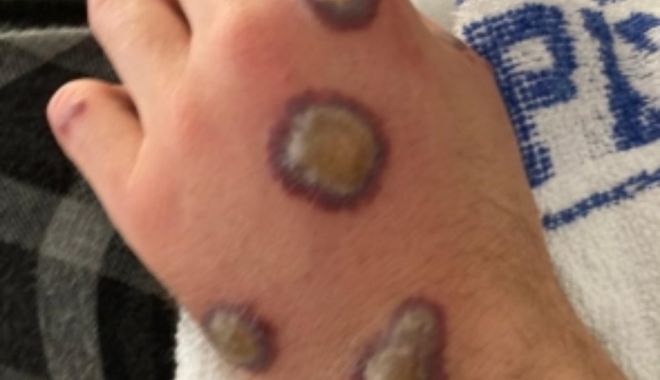 Ce spun medicii despre varianta de variola maimuţei, depistată în Portugalia