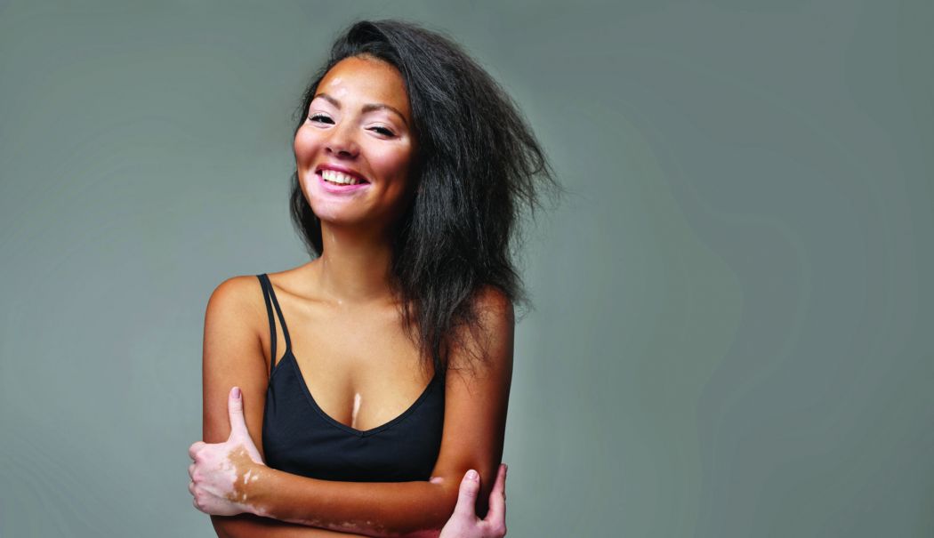 Suferiți de vitiligo? Mare atenție cu expunerea la soare! - vitiligo-1750689168.jpg