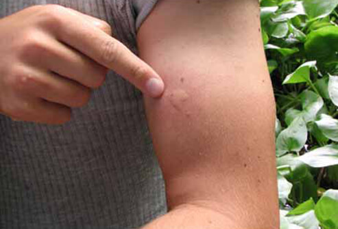 Încă două persoane au murit în urma infectării cu West Nile - westnileviruss5photoofmosquitobi-1474700721.jpg