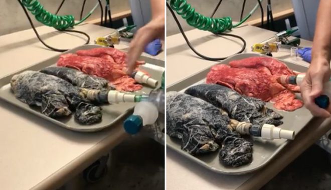VIDEO. Așa arată plămânii unei persoane care a fumat timp de 20 de ani - wu0ktkpturbxy8wnwe3mgvhmdrlztyzy-1525935181.jpg