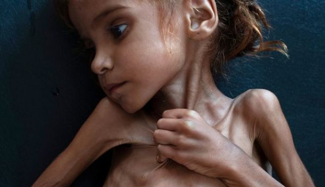 A MURIT fetița care a devenit simbolul crizei umanitare din Yemen - xtvxkfaf75ffbcjzfsr3f2g6bi-1541148242.jpg